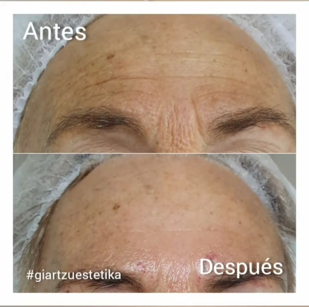 Antes y después del tratamiento