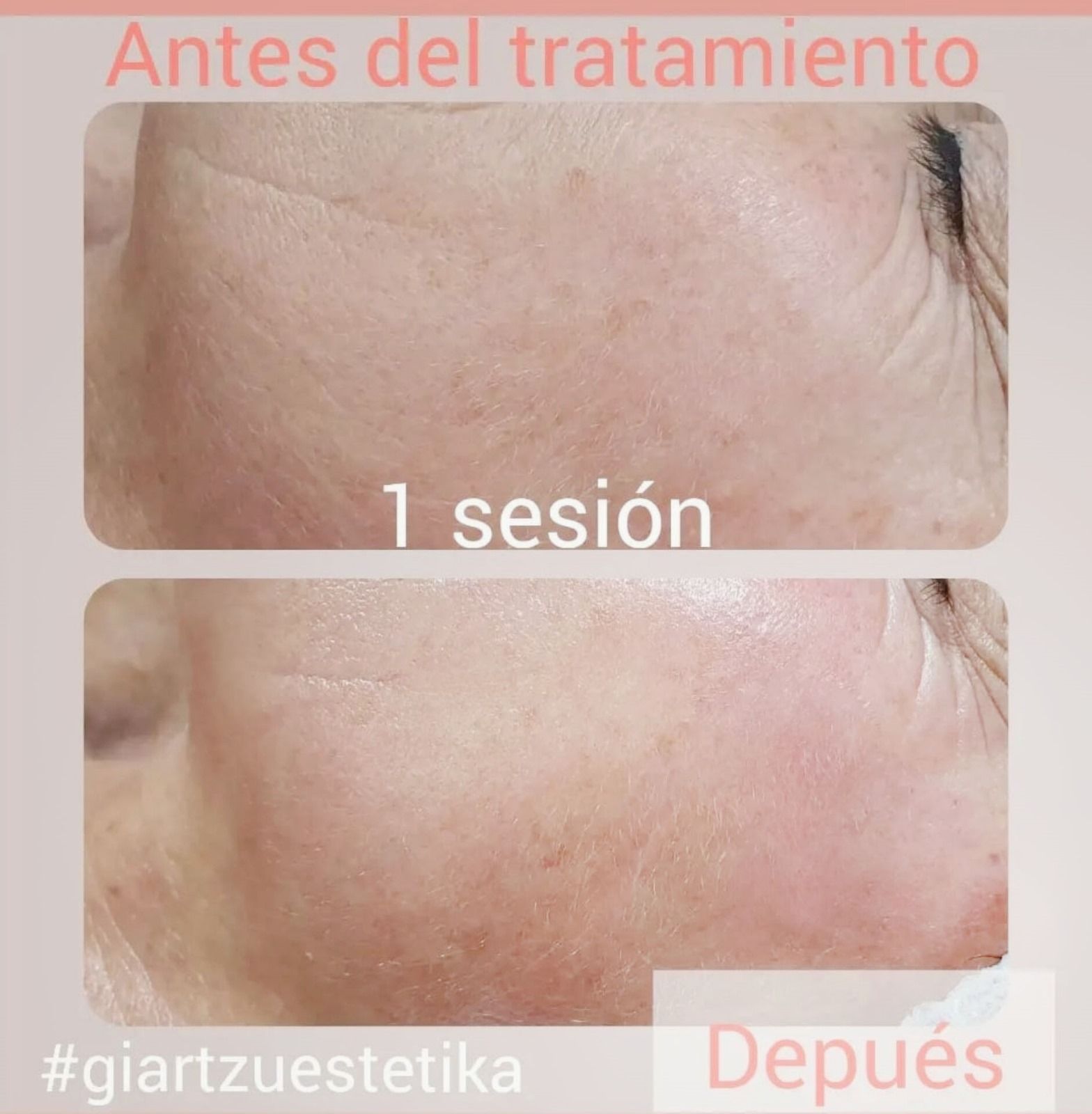 Antes y después del tratamiento